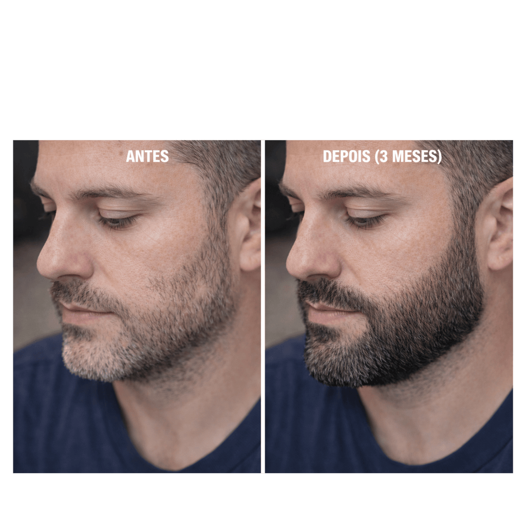 Minoxidil Turbinado - Spray