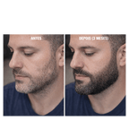 Minoxidil Turbinado - Spray