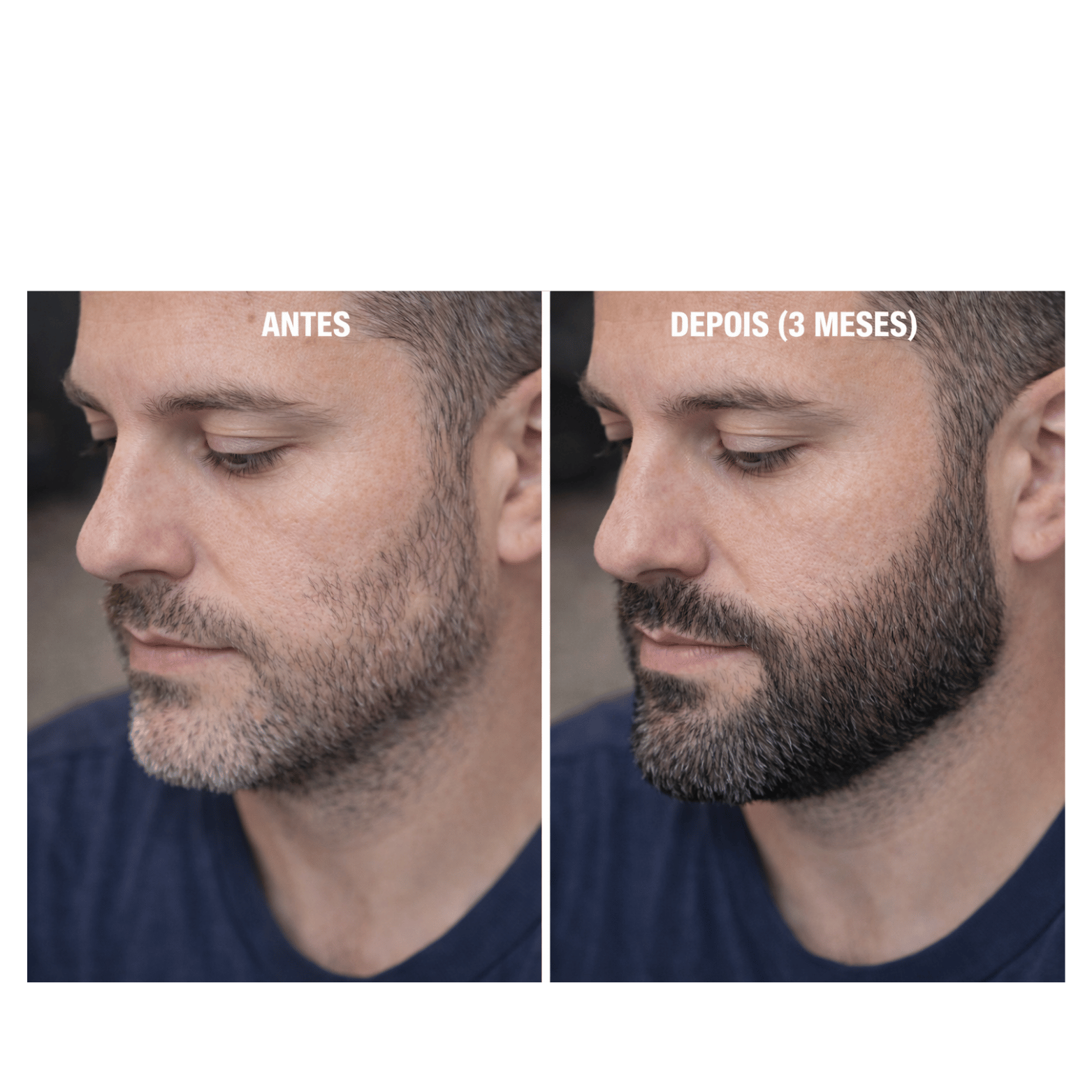 Minoxidil Turbinado - Spray