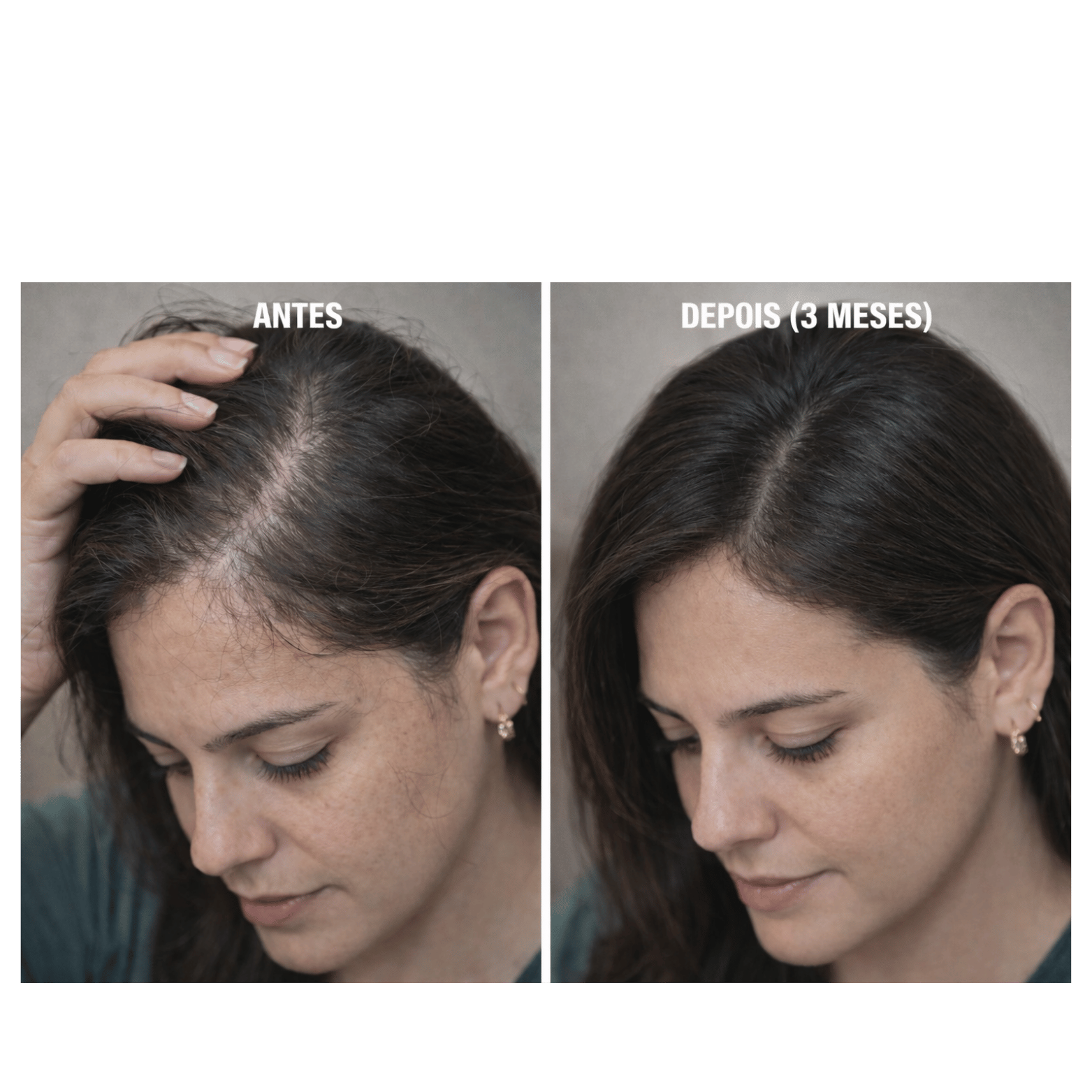 Minoxidil Turbinado - Spray