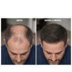 Minoxidil Turbinado - Spray