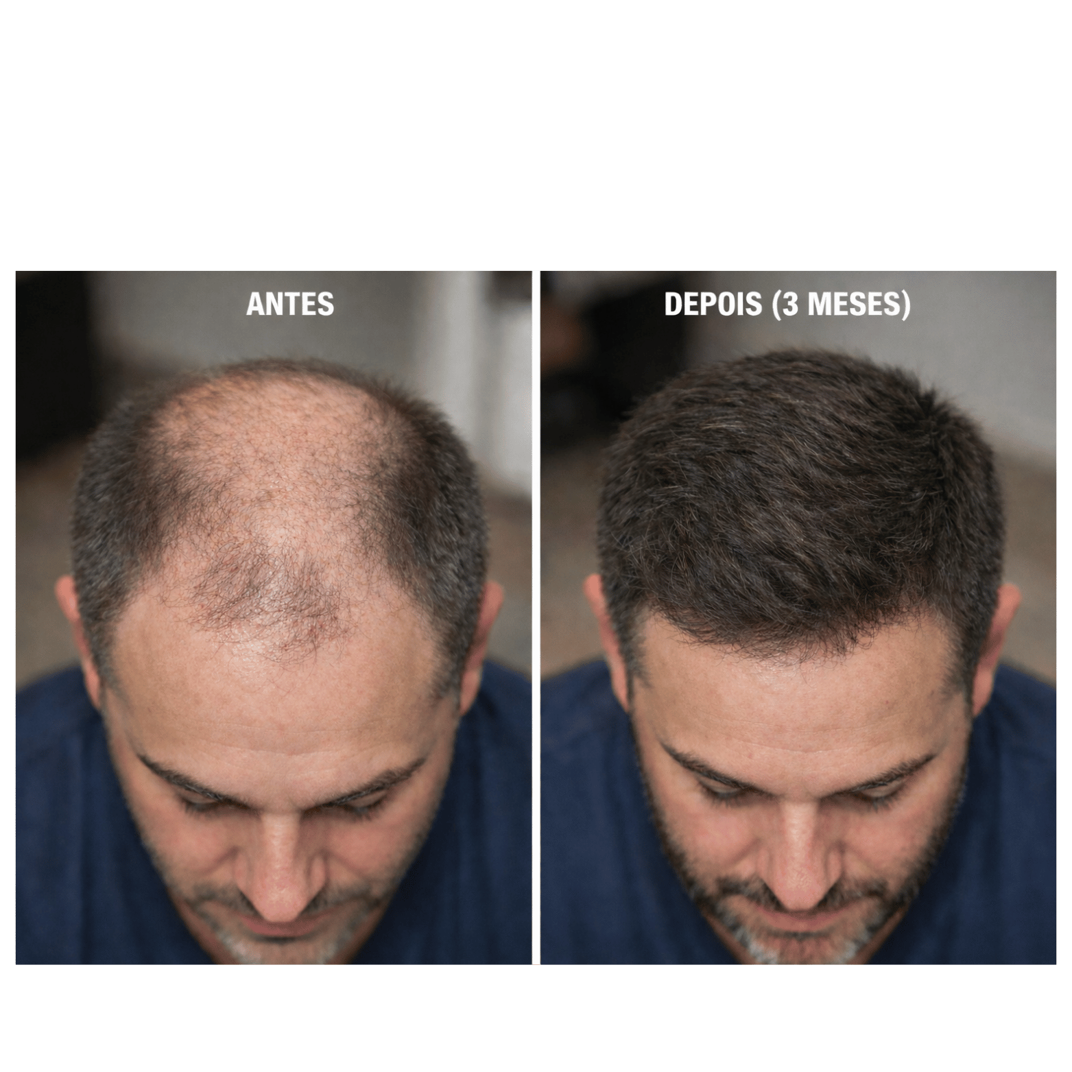 Minoxidil Turbinado - Spray